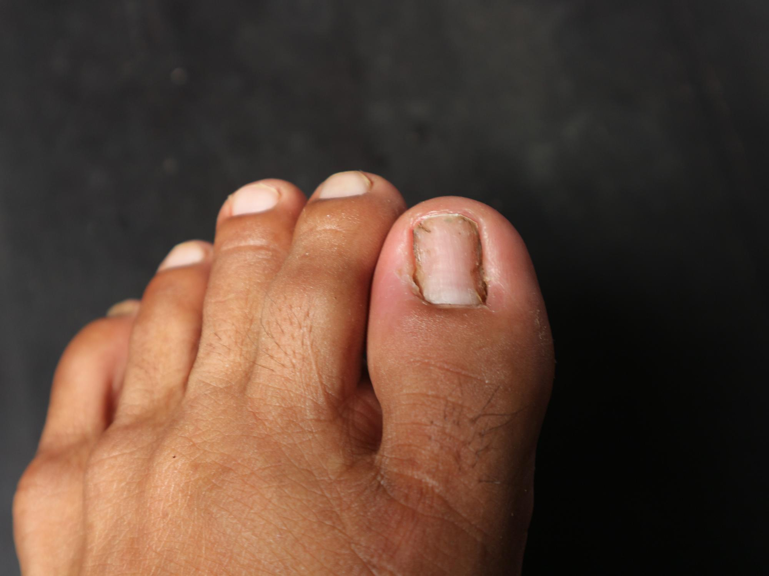 ingrown toenails
